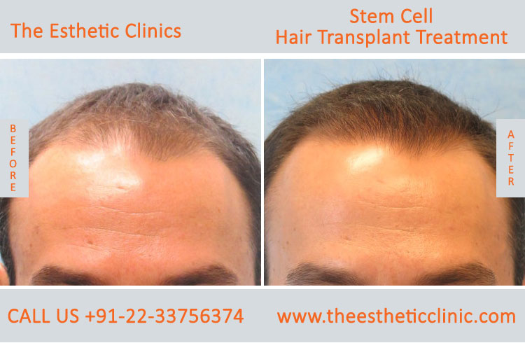 Stem Cell Hair Transplant Treatment before after photos in mumbai india (3)